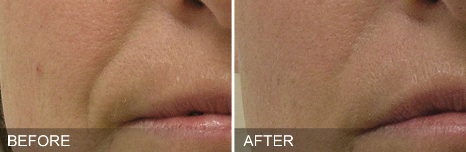 HydraFacial - Before & After for Nasolabial Folds